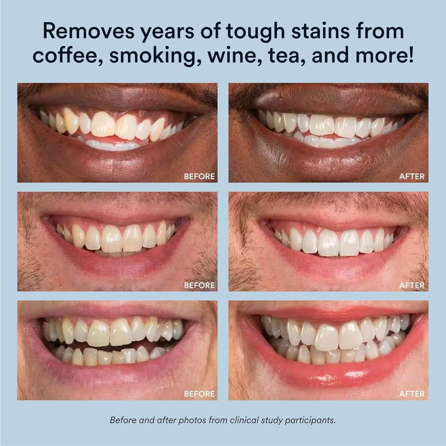 Elite™ teeth whitening pen