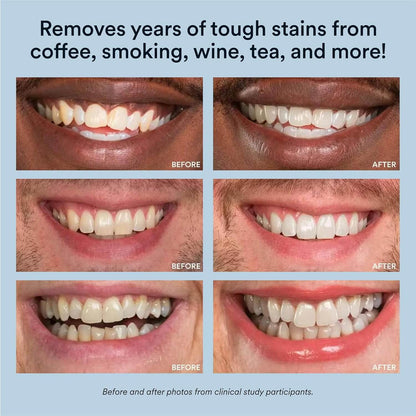 Elite™ teeth whitening pen