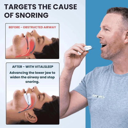 Elite™ Anti-Snoring Mouth Guard